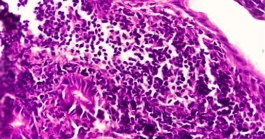 Lung cancer immunotherapy research