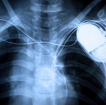 Medical device pacemaker xray thumbnail