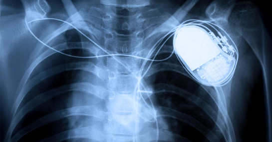 Medical device pacemaker xray thumbnail