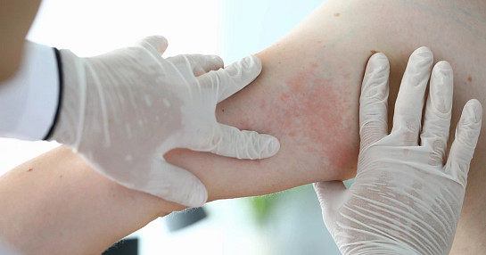 psoriasis skin disease dermatology